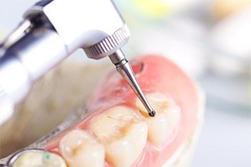 Precio De Una Endodoncia En Madrid